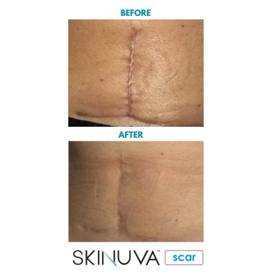 Kết quả sau 3 tháng sử dụng Skinuva Scar với vết sẹo phẫu thuật ở bụng