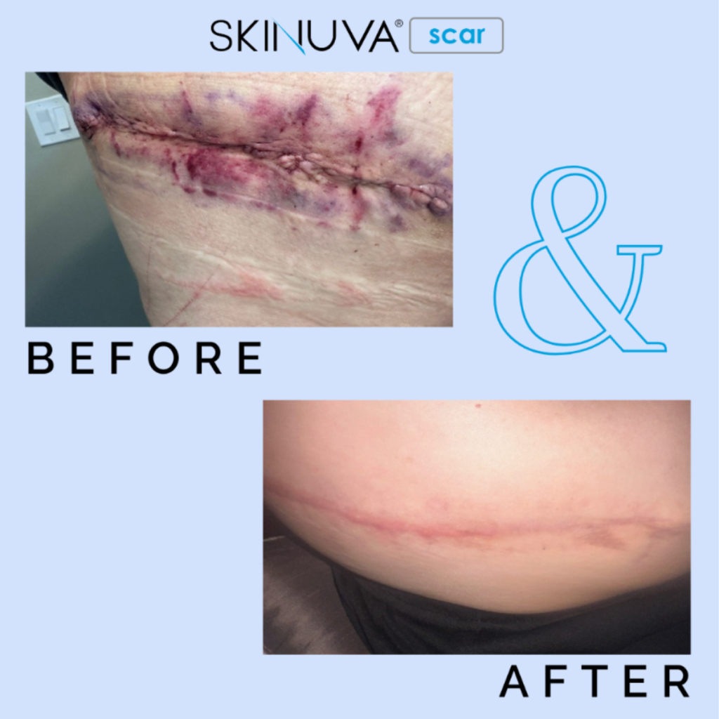Trước và sau khi điều trị sẹo phẫu thuật bằng Skinuva Scar