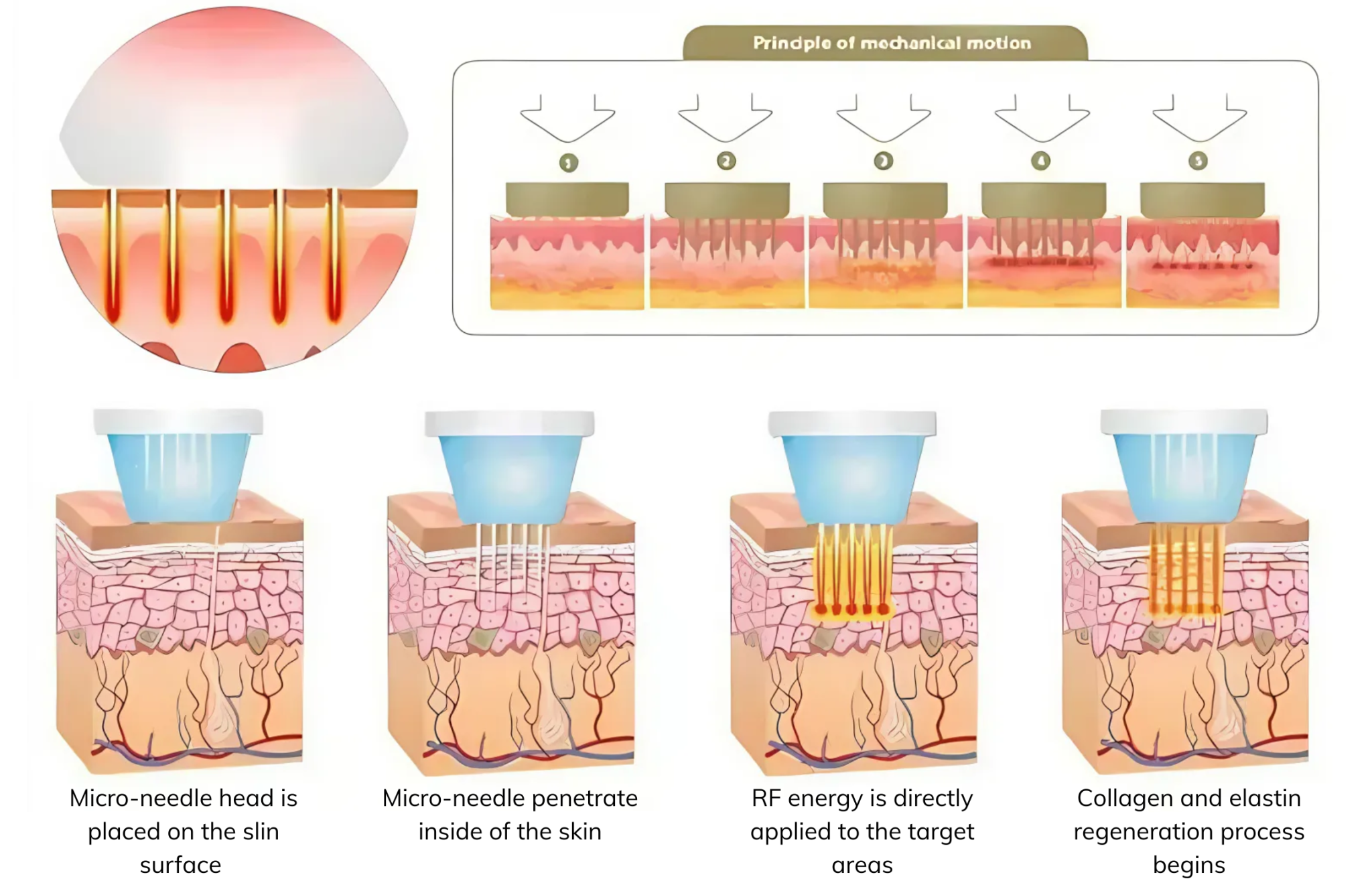 Microneedling RF L G Ch c N ng V C ng D ng C a RF Microneedling microneedling-rf-l-g-ch-c-n-ng-v-c-ng-d-ng-c-a-rf-microneedling
