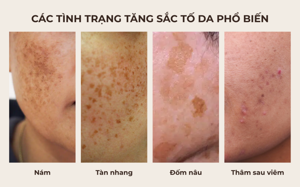 Các tình trạng tăng sắc tố da phổ biến