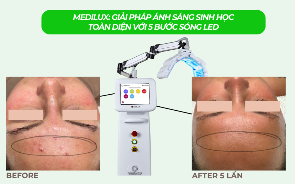 Kết quả điều trị bằng công nghệ đèn ánh sáng sinh học MediLUX