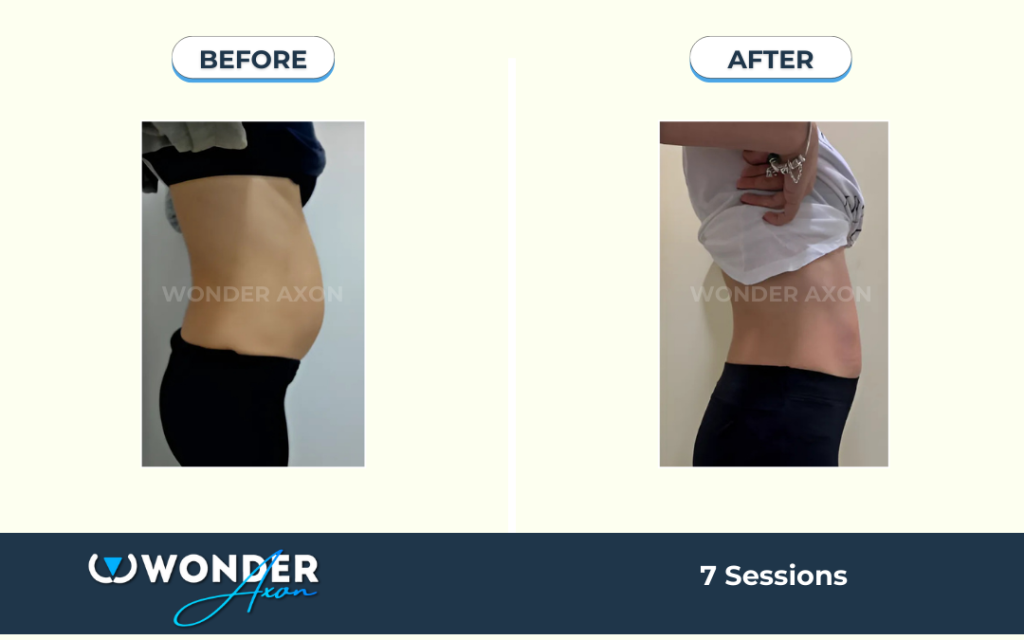 Kết quả siết eo S-line định hình vóc dáng bằng Wonder Axon