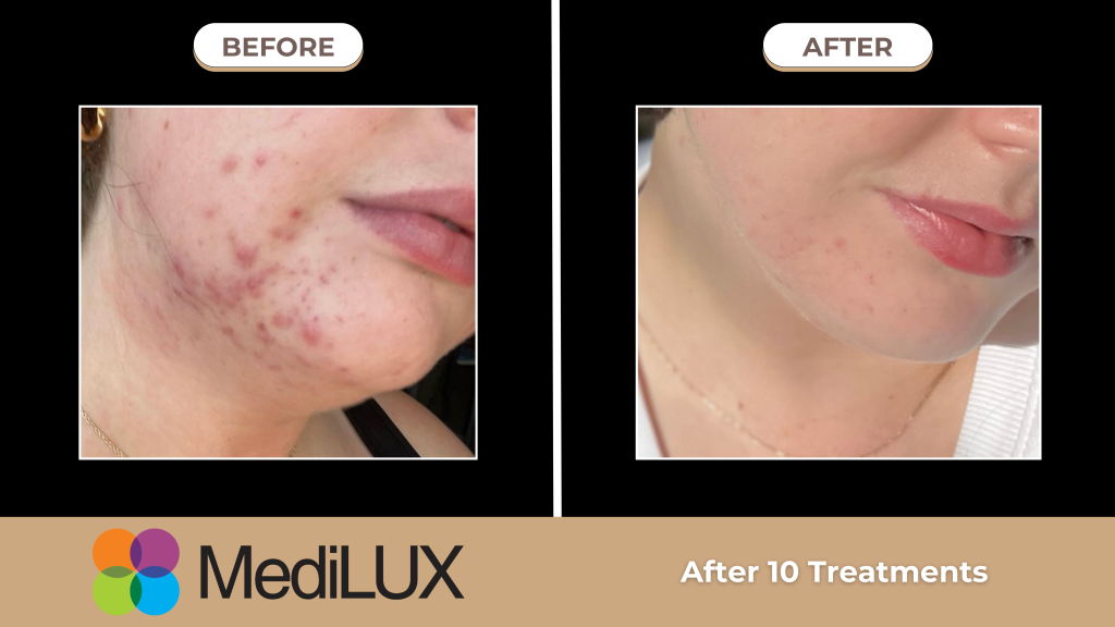 Before - After trị mụn bằng đèn ánh sáng chuẩn light therapy