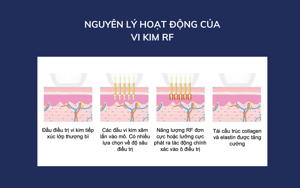 Nguyên lý hoạt động của RF vi kim