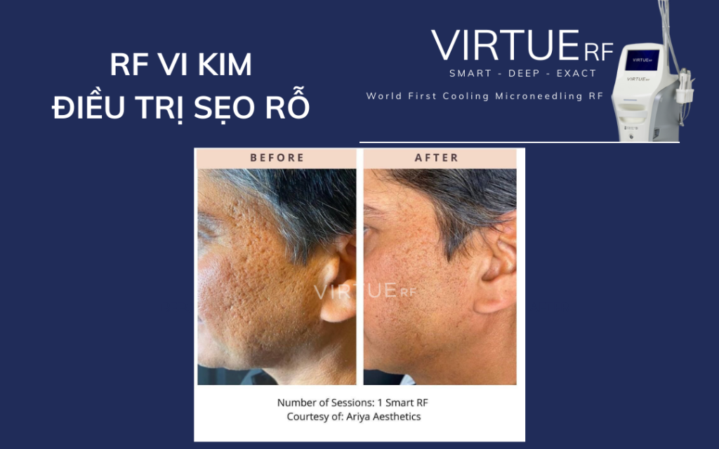Kết quả điều trị sẹo rỗ bằng Virtue RF Microneedling