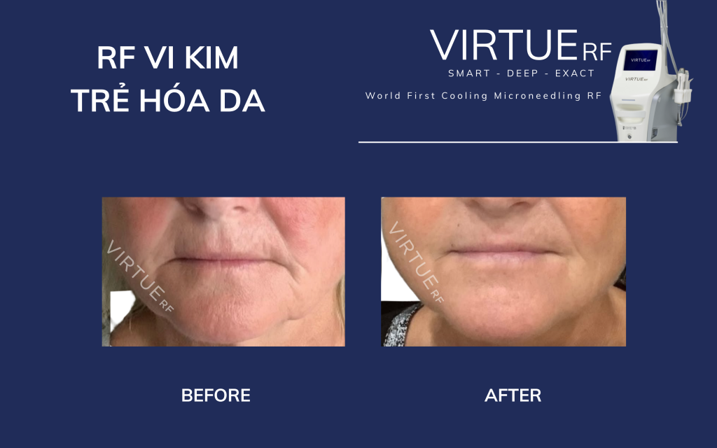 RF Needling trong trẻ hóa da