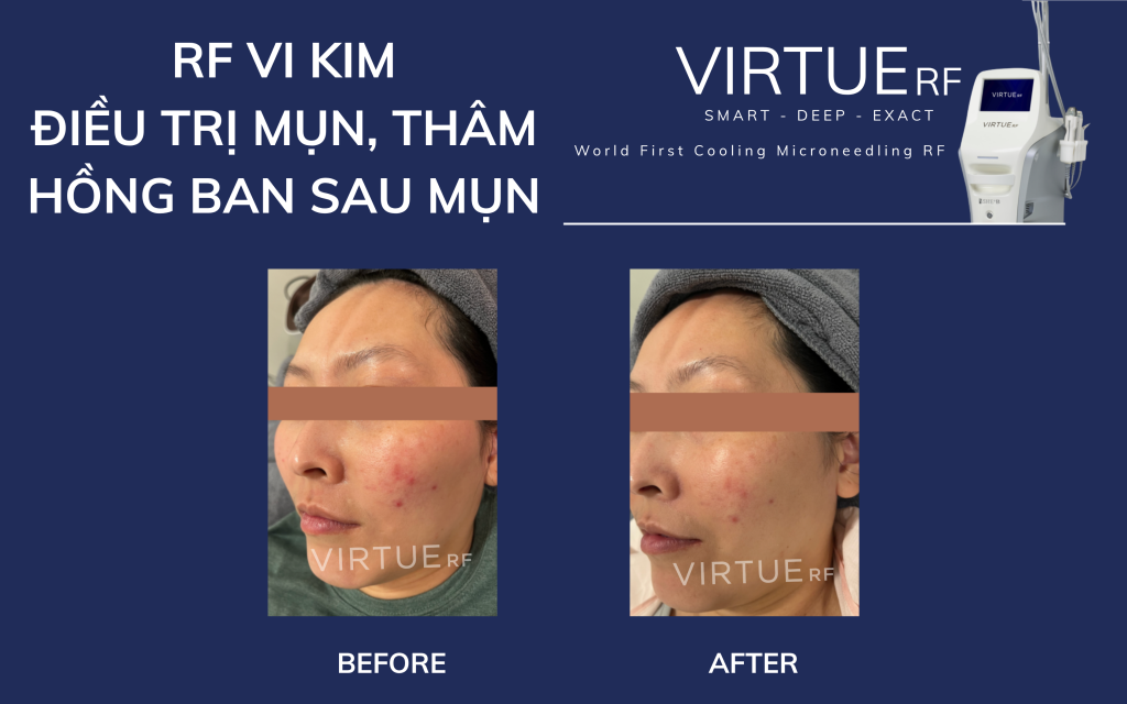 RF Needling trong trị mụn thâm và hồng ban sau mụn