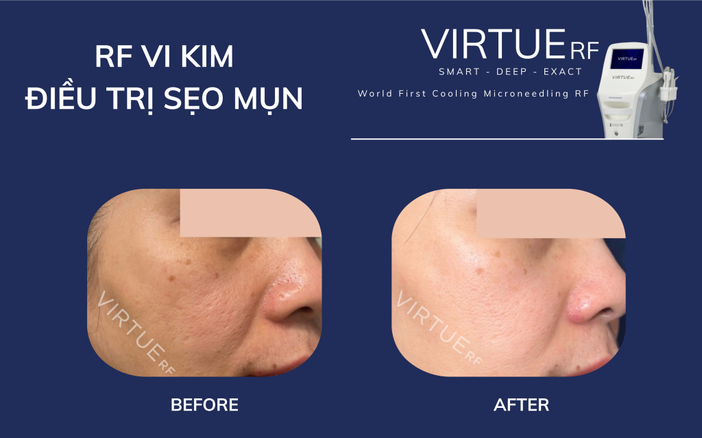 RF Needling trong trị sẹo mụn