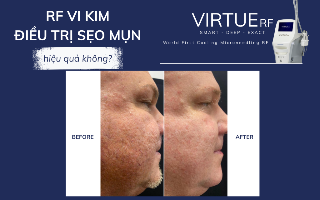 RF vi kim điều trị sẹo mụn có hiệu quả không