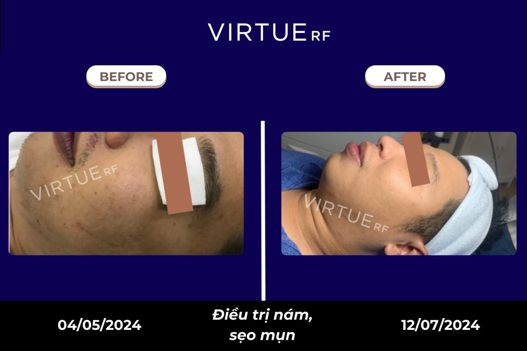 Da nào phù hợp điều trị bằng Mironeedling RF