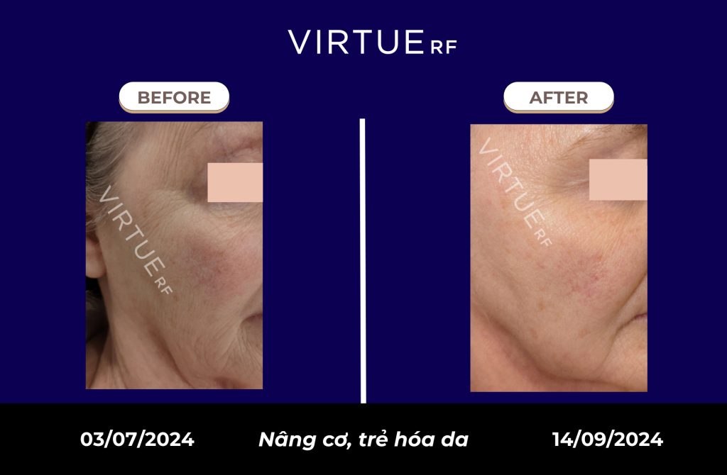 Mironeedling RF (Microneedle RF) là gì? Kết quả điều trị đáng ngạc nhiên từ Virtue Microneedling RF