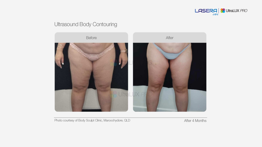 Kết quả định cơ thể bằng công nghệ Ultrasound của UltraLUX PRO