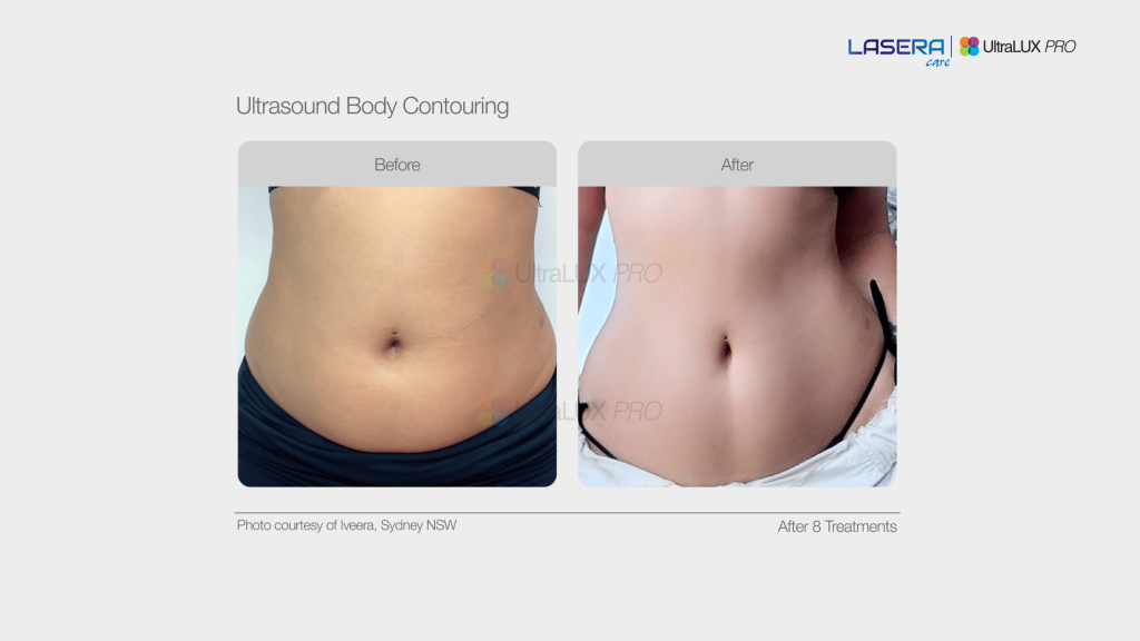 Kết quả định hình vóc dáng bằng công nghệ Ultrasound của UltraLUX PRO