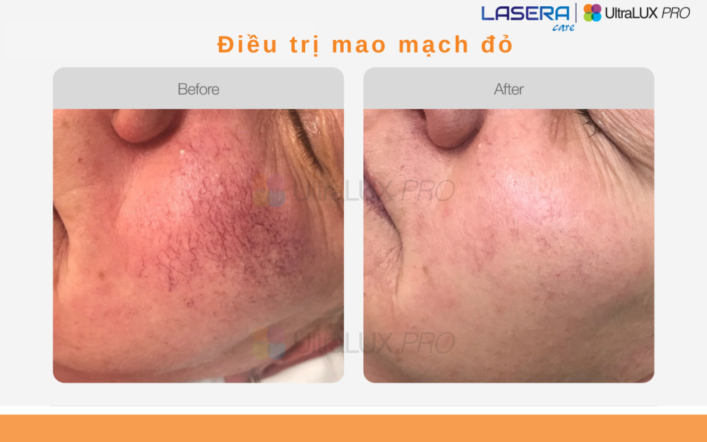 Điều trị giãn mao mạch bằng công nghệ IPL UltraLUX PRO