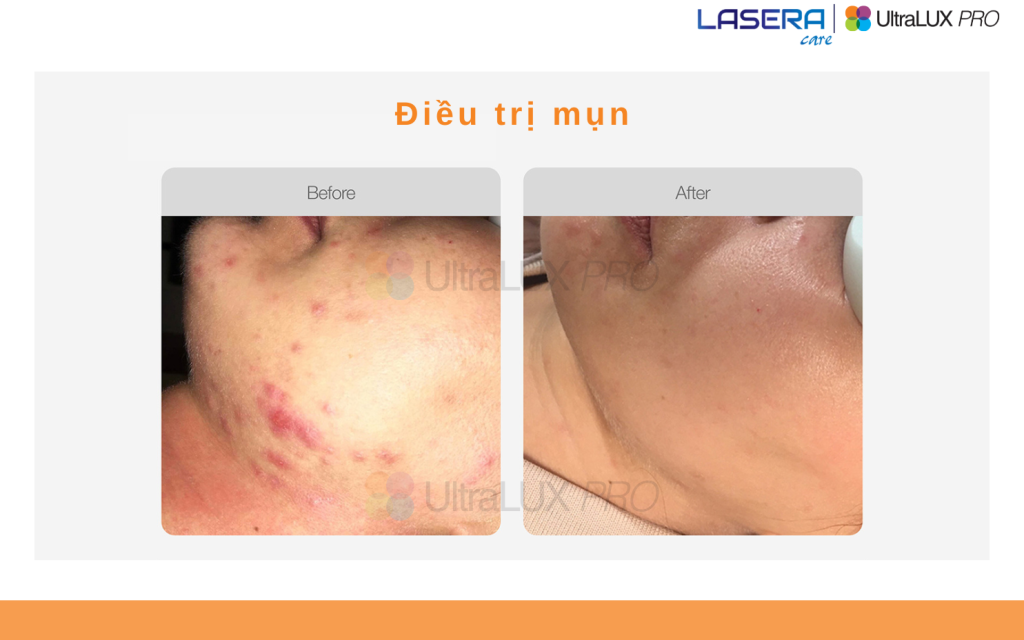 Điều trị mụn chuẩn y khoa bằng công nghệ IPL UltraLUX PRO