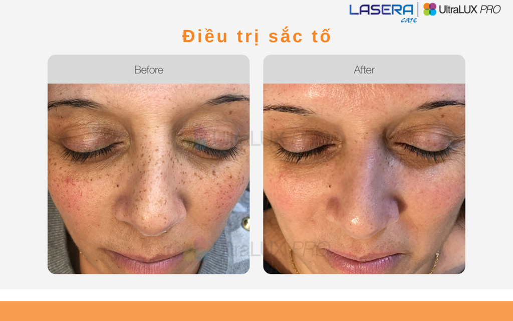 Điều trị sắc tố da bằng công nghệ IPL UltraLUX PRO