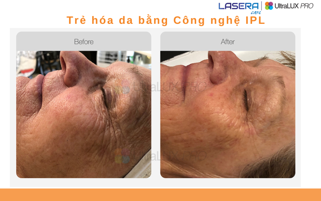 Trẻ hóa da bằng công nghệ IPL UltraLUX PRO