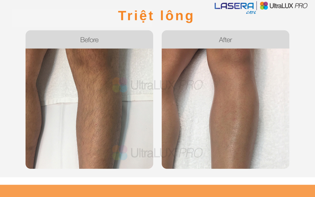 Triệt lông vĩnh viễn bằng công nghệ IPL UltraLUX PRO