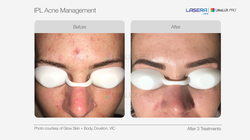 Kết quả điều trị mụn theo chuẩn y khoa bằng UltraLUX PRO