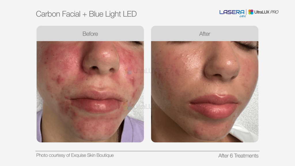 Carbon Facial kết hợp chiếu ánh sáng sinh học MediLUX blue