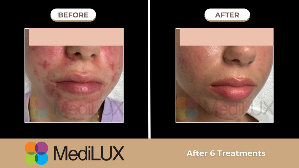 Ánh sáng sinh học điều trị mụn viêm trên da