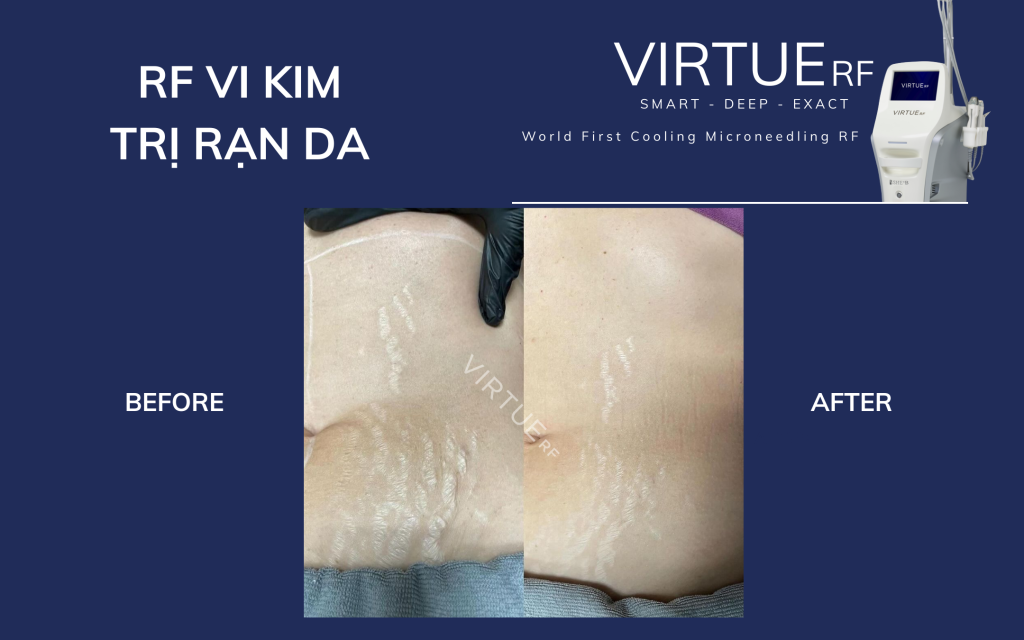 Điều trị rạn da bằng RF vi kim (Virtue RF)