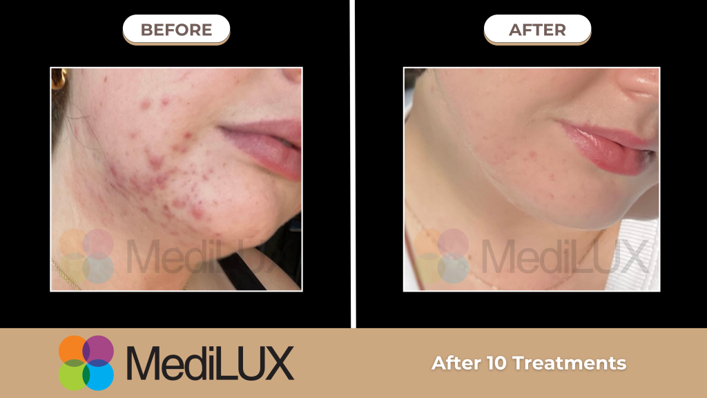 Kết quả trị mụn bằng ánh sáng sinh học