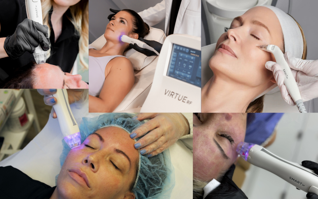 Công nghệ RF vi kim Virtue không tốn thời gian nghỉ dưỡng sau điều trị