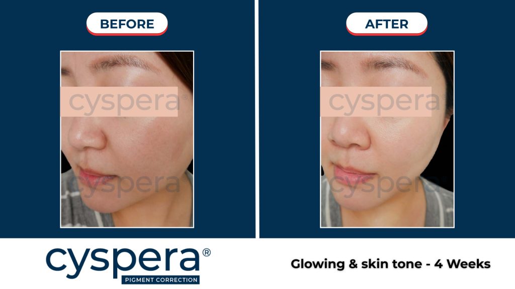 Hiệu quả điều trị nám bằng cysteamine 7%