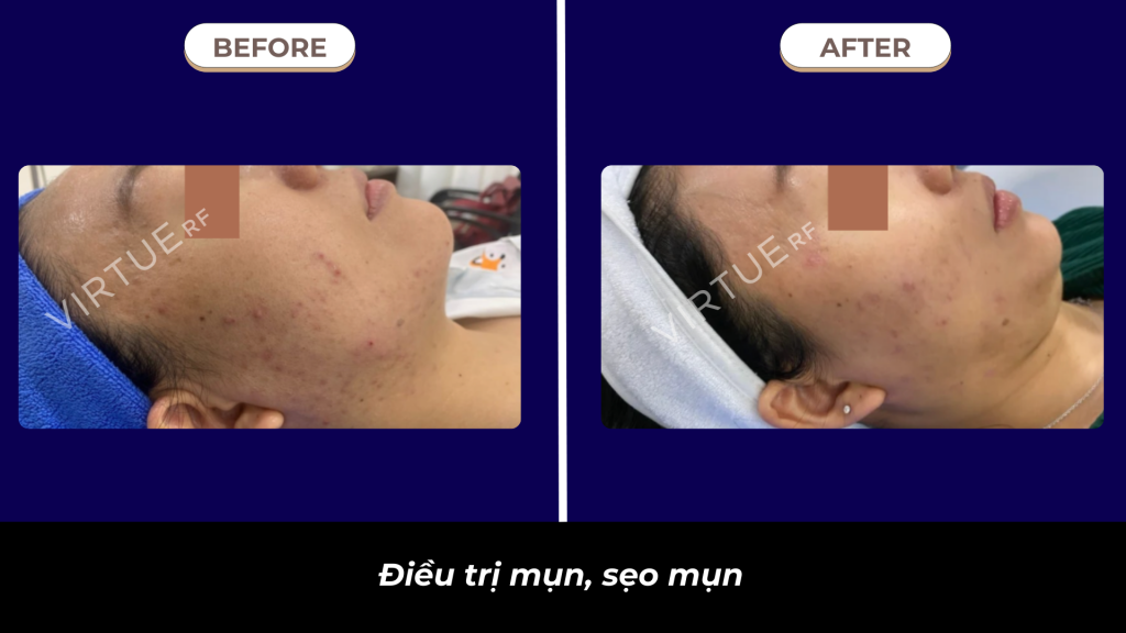 Kết quả điều trị mụn và sẹo mụn bằng Virtue RF Microneedling Cooling system