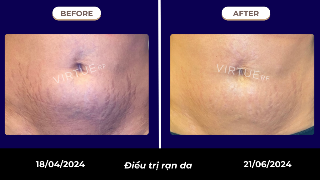 Kết quả điều trị rạn bụng bằng Virtue RF Microneedling