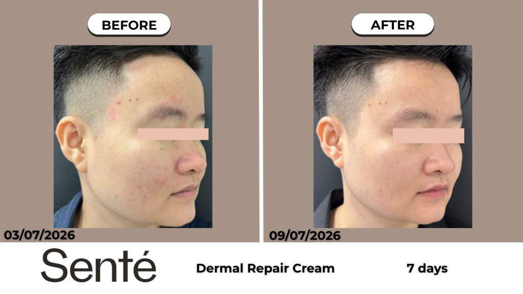 Kết quả sử dụng HSA kết hợp Retinol giúp giảm viêm, giảm đỏ