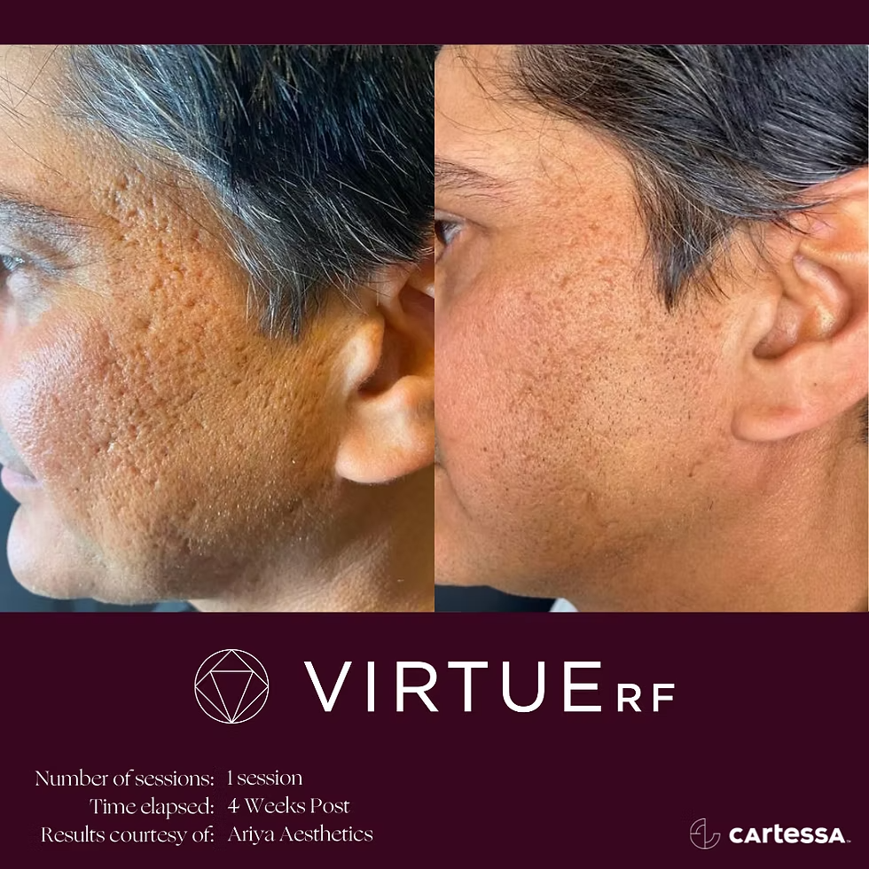 Microneedling RF trong điều trị sẹo rỗ