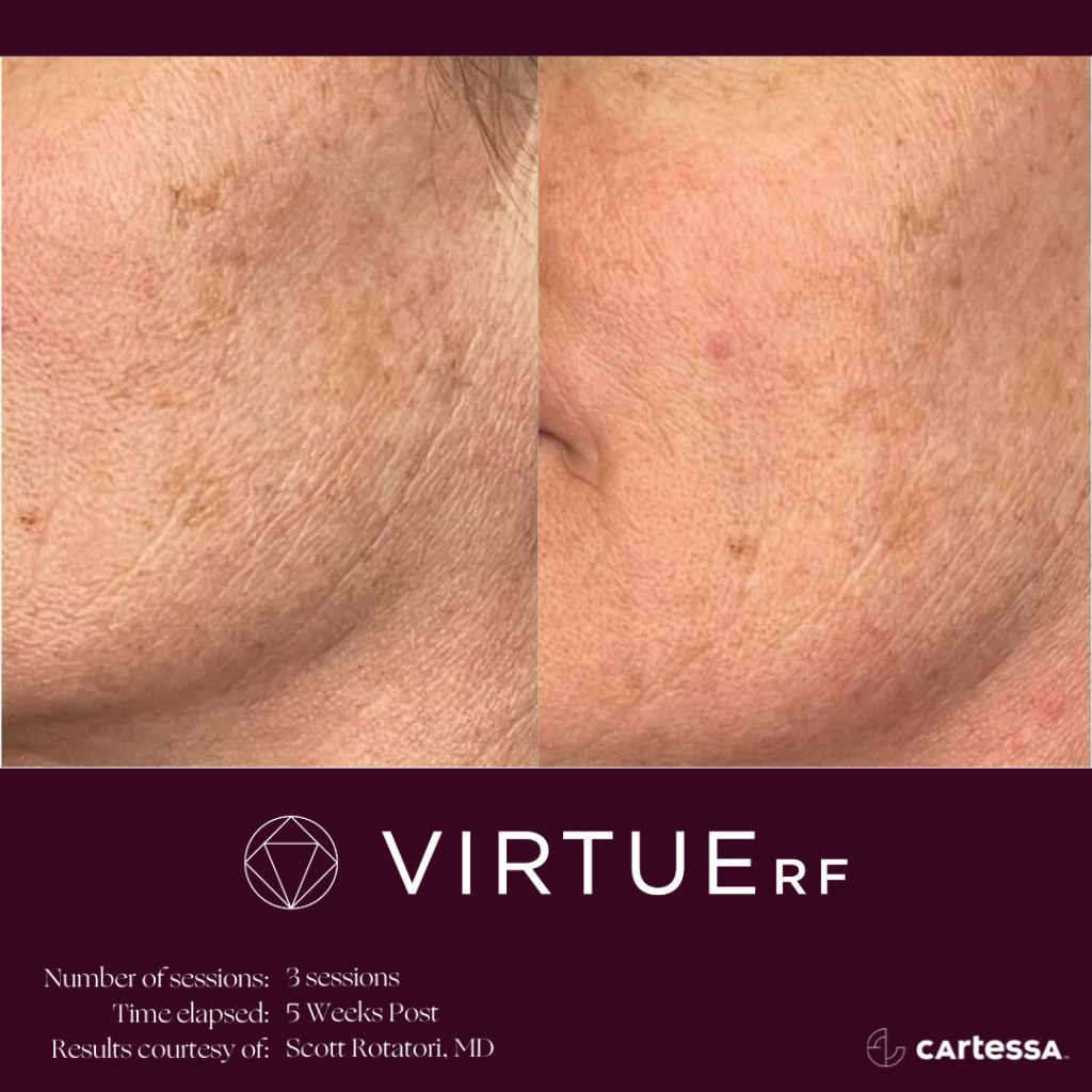 Microneedling RF trong trẻ hóa da, làm mờ vết nhăn và cải thiện kết cấu da