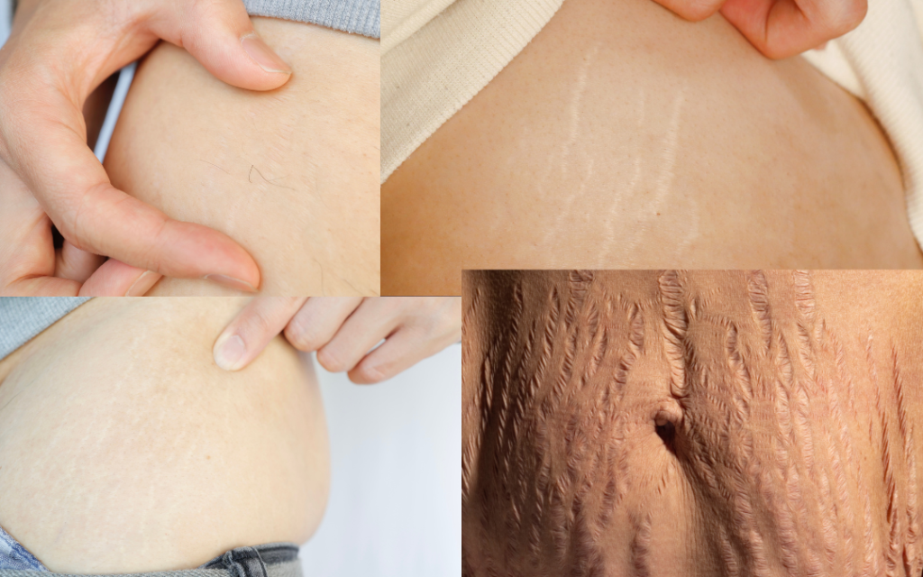 Kết quả microneedling RF trị rạn da dựa theo cơ địa và tình trạng rạn của từng người
