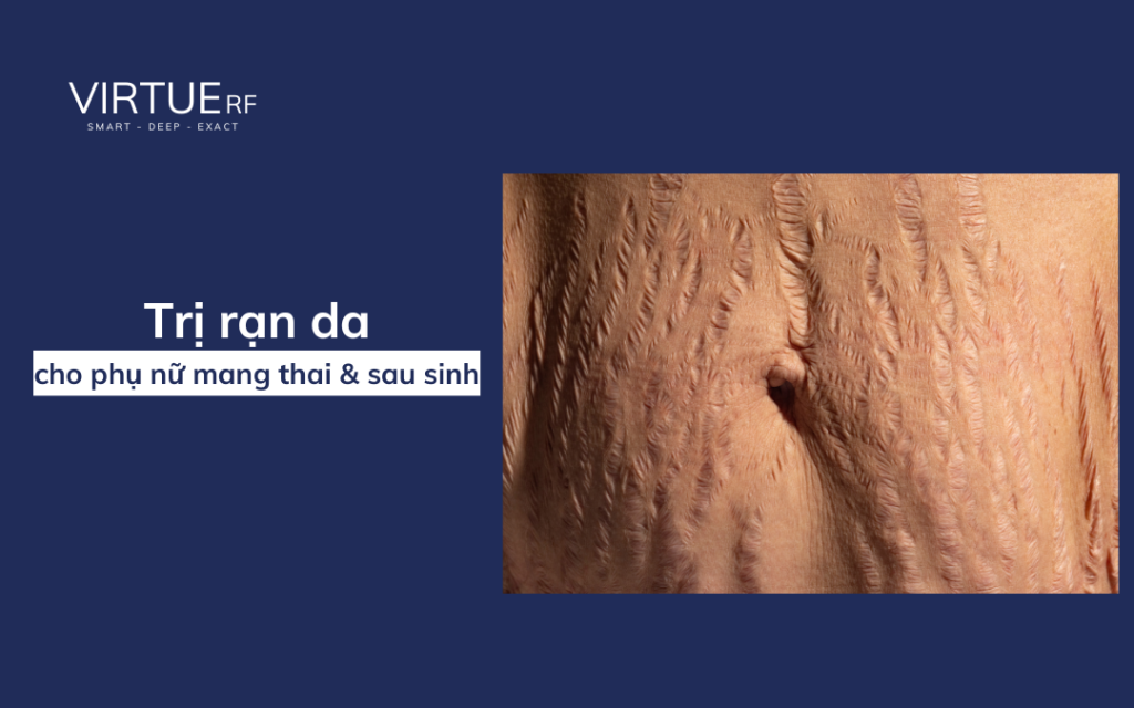 Virtue Microneedling RF trị rạn da có hiệu quả không?